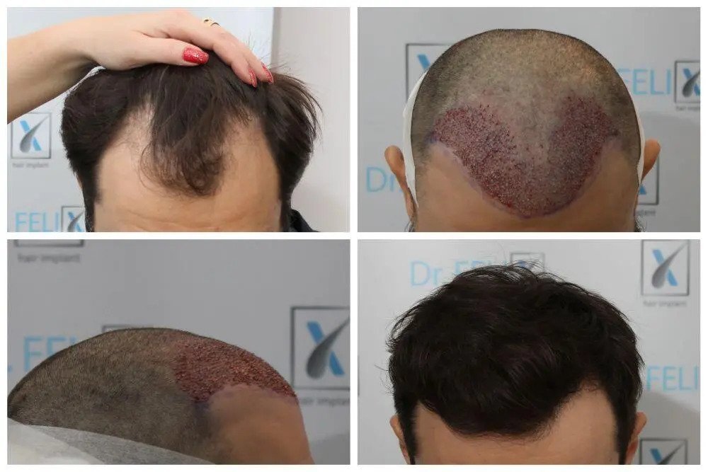 Implant de par in Bucuresti pentru barbati pentru o podoapa capilara bogata – Dr Felix Hair Implant